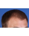 Before Hair Transplant&nbsp;Front